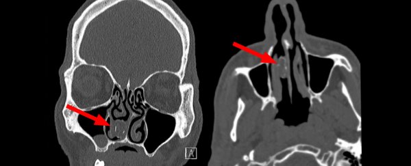 This man had a drug parcel stuck inside his nose for 18 years