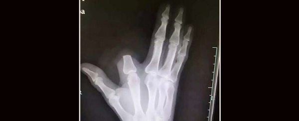 Chinese man chops off own finger after snake bite, doctors say it was unnecessary