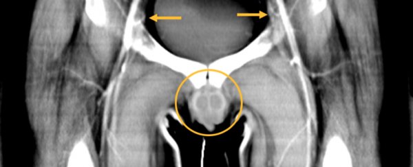 World's first penis and scrotum transplant is fully functional over one year on