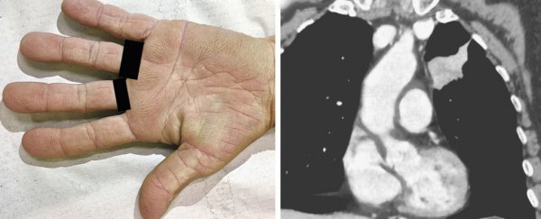 This woman's velvety 'tripe palms' ended up being a symptom of cancer