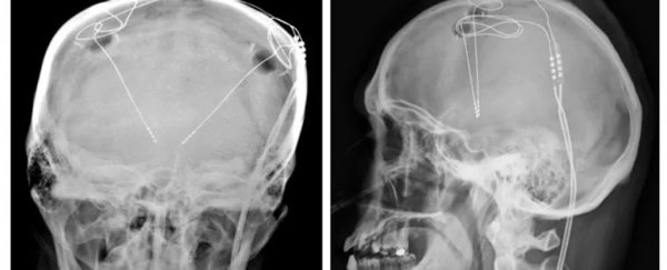 In US first, an opioid addicted patient has had electrodes implanted into his brain