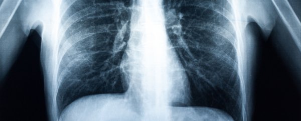 Doctors say they've performed the first double lung transplant due to vaping
