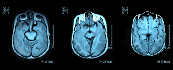 People with autism have more symmetrical brains. Here's what that could mean