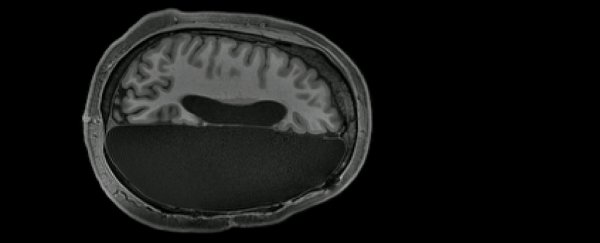 Remarkable MRI study reveals how some people function with only half a brain
