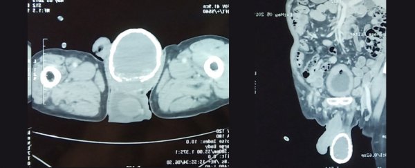 Man develops rare condition causing an 'eggshell' to grow on his testicle