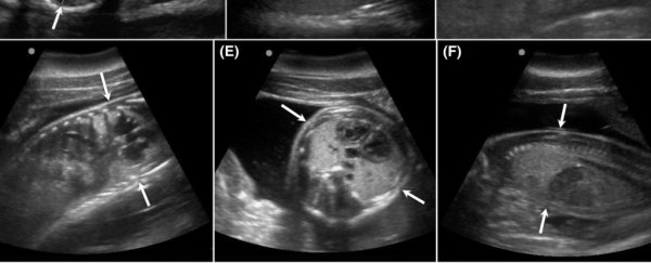 First detailed ultrasound images of pregnant dolphins are both beautiful and tragic