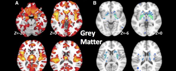 Brain scans reveal a new schizophrenia type that almost looks like a 'healthy' brain