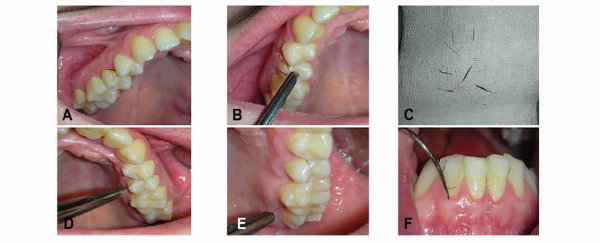 Woman Grows Hairs Out of Her Gums In An Extremely Rare Medical Case