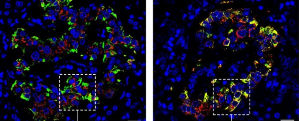 Type 1 diabetes looks like it's actually 2 separate diseases, scientists find