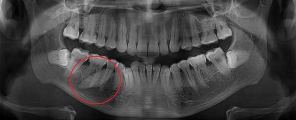 Giant Salivary Stone Growing in Man's Mouth Was So Big It Was Mistaken For A Tooth