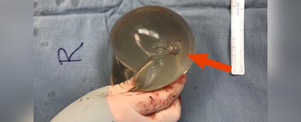 Woman's breast implant saved her life by deflecting a bullet, case study shows
