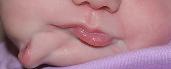 This rare condition caused a baby to be born with a second mouth