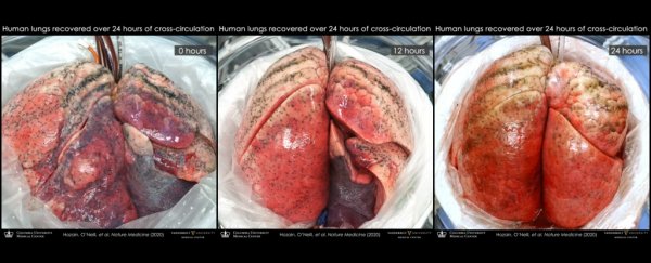Damaged human lungs can be repaired by attaching them to pigs, experiment shows