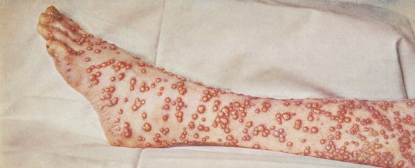 Ancient viral DNA from Viking Age corpses just got us closer to the origin of smallpox