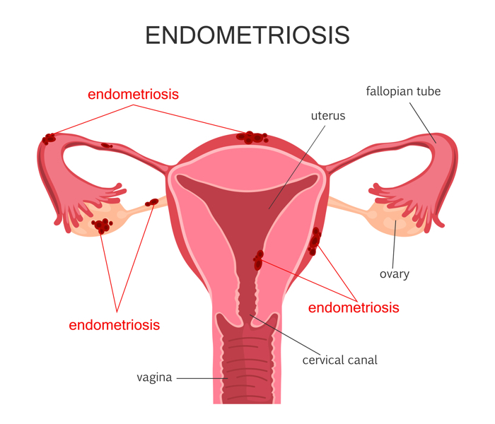 010 endo symptoms