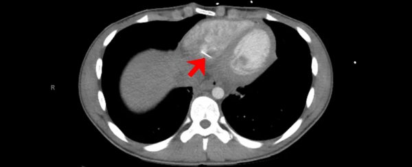 A Teenager Didn't Realise He'd Swallowed a Sewing Pin Until It Pierced His Heart