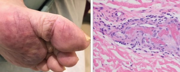 Some coronavirus patients are getting rashes, and it may signal underlying issues