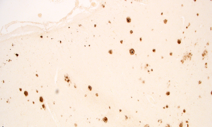 Protein plaques in brain tissue
