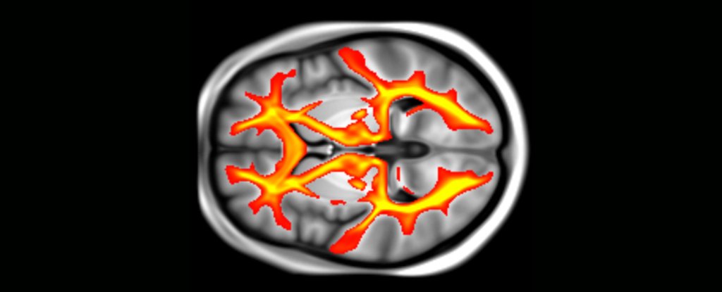 MRI brain scan from the UK Biobank showing white matter pathways. 