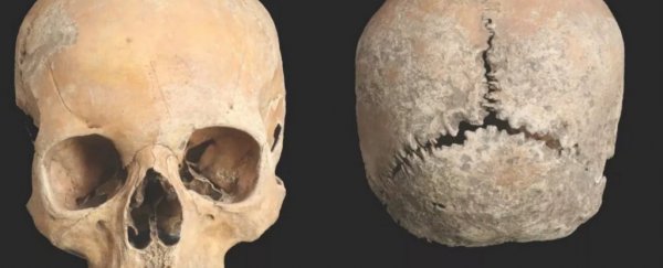 Skull shows an Anglo-Saxon teen had her nose and lips cut off 1,100 years ago