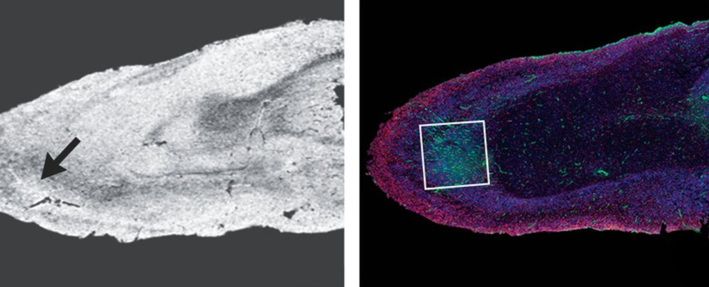 Brain microscopy showing hyperintensities 