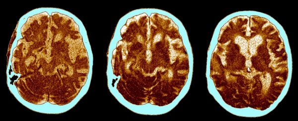 Research Says Alzheimer's Is Actually 3 Distinct Disease Subtypes