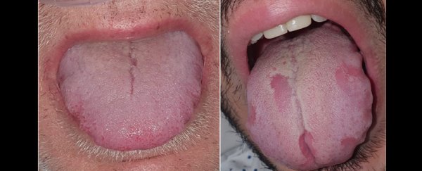 'COVID tongue' could be one of the signs of infection, doctors warn