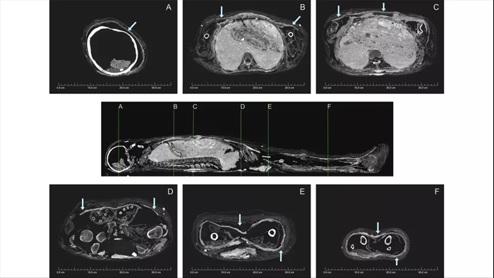 Internal features of a CT scan of the mud mummy