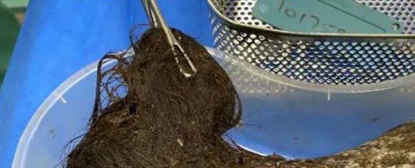 Teen With 'Rapunzel Syndrome' Requires Surgery After Giant Hairball Fills Stomach