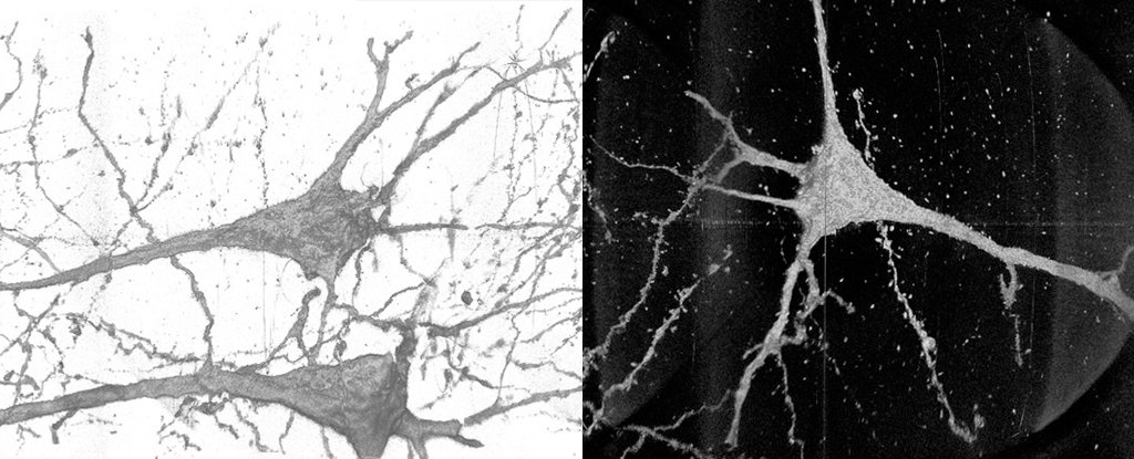 3D X-ray images of schizophrenia neurons. 