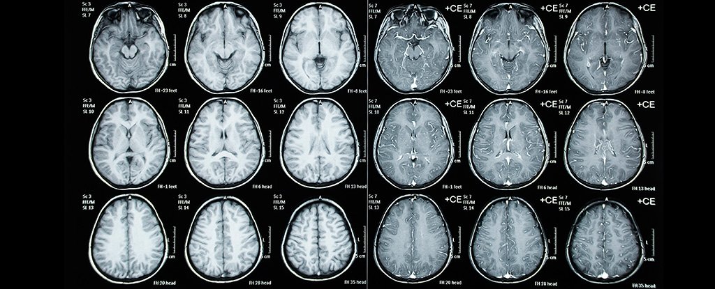 CT scan of a child's head. 