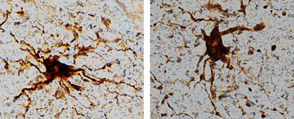 Neuroscientists detect confused 'zombie' cells in the human brain after death
