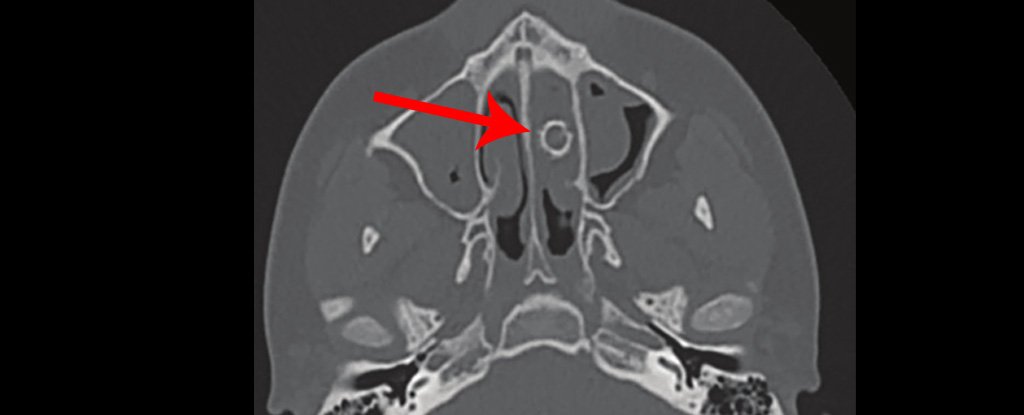CT scan of the teen's nose, showing pellet in nasal cavity. 