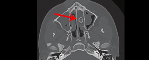 A foreign object stuck in teen's nose for 8 years led to a 'mysterious odor'