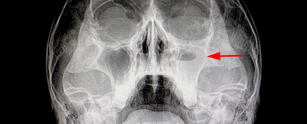 X-ray showing acute sinusitis. 