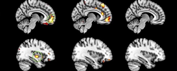 The brain's pleasure system wastes away in early-onset dementia, study finds