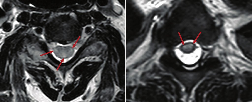 MRI showing inflammation of the spinal cord. 