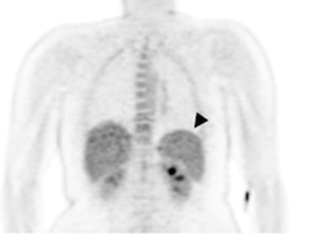 Malaria parasites in spleen