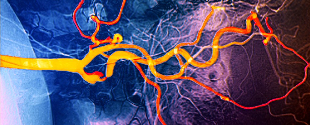 Carotid artery. 