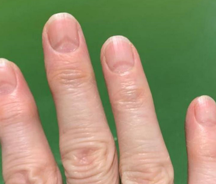 Reports Are Emerging of 'COVID Nails'. Here's What You Need to Know :  ScienceAlert