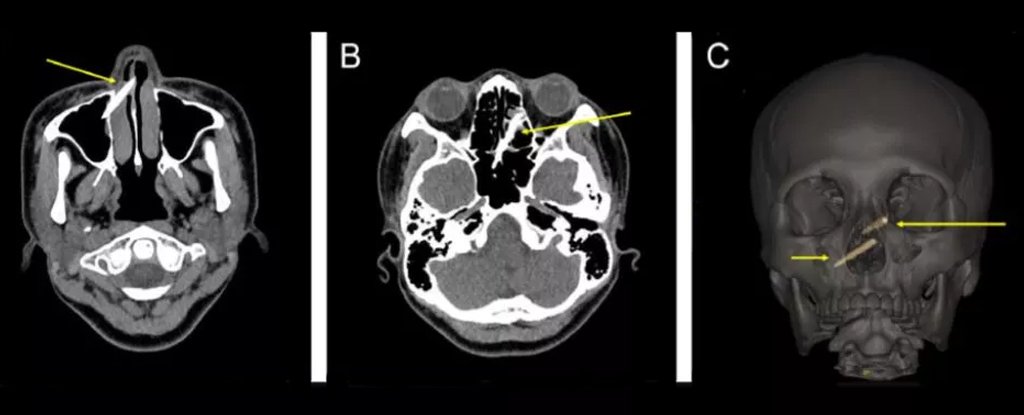 Woman Ends Up With Chopstick Fragments Undetected in Her Sinuses For a Week