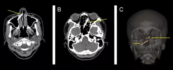 Woman ends up with chopstick fragments undetected in her sinuses for a week