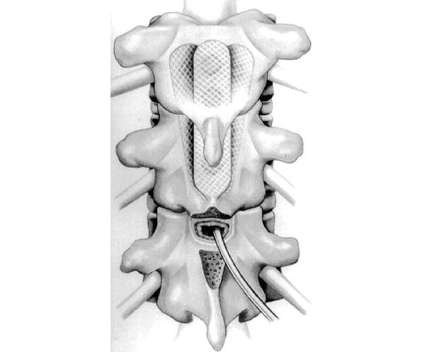 vertebra opening lamination implant