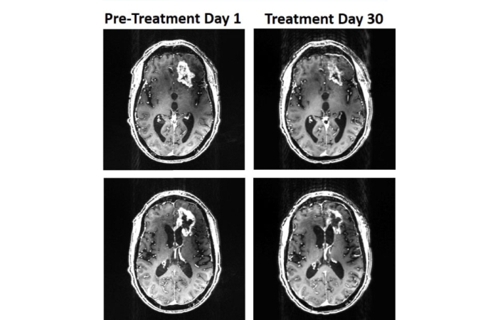 glioblastoma scans from the patient