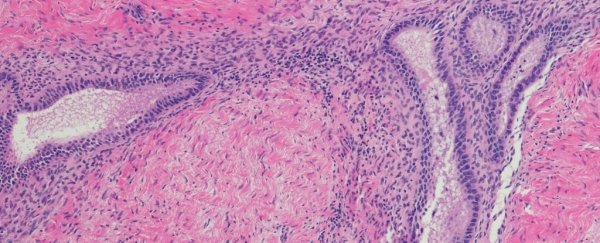 Knowing this specific gene can cause endometriosis could lead us to better treatments