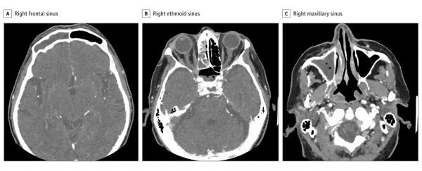 A COVID-19 patient lost vision in one eye. Here's how they could be connected