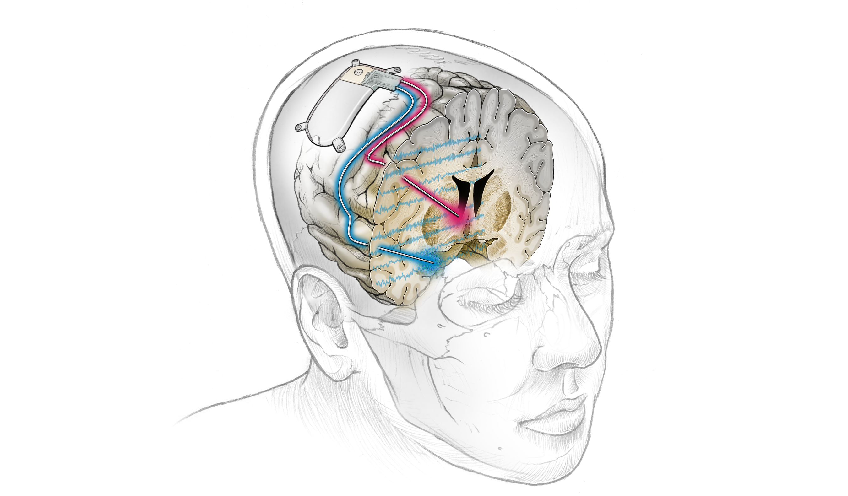 Boucle ferméeDBS Brain 03SenseStimSignal