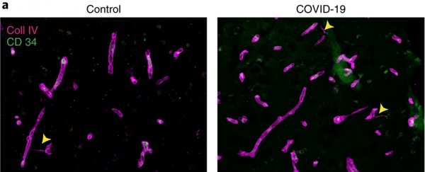 COVID-19 can damage blood vessels in the brain, causing neurological symptoms