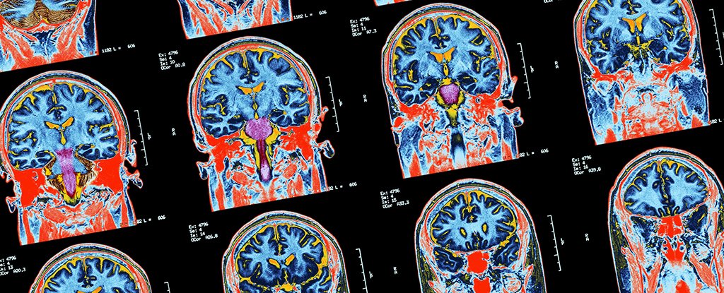 Brain Signals Associated With OCD Discovered by Scientists For First Time
