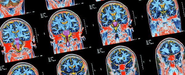 Brain signals associated with OCD discovered by scientists for first time